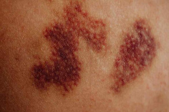 Plaque rouge sur le corps sans démangeaison : le stress peut-il être en cause ?-Objectif : Zéro Miette!